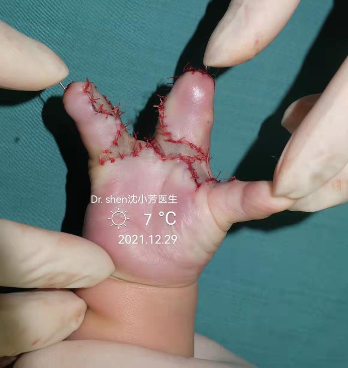 这个孩子来自山西,手指严重的发育不良并指,手术分离中环指同时要松解