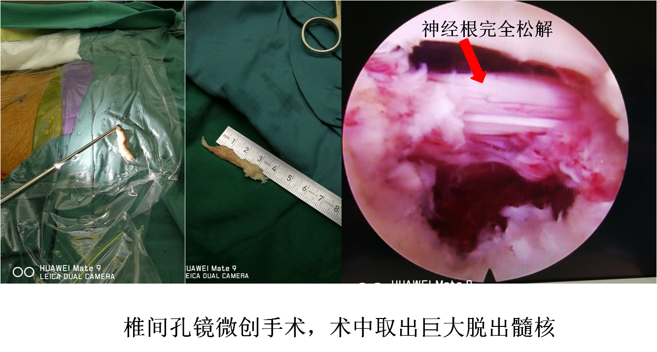腰椎间盘突出症的椎间孔镜手术1例