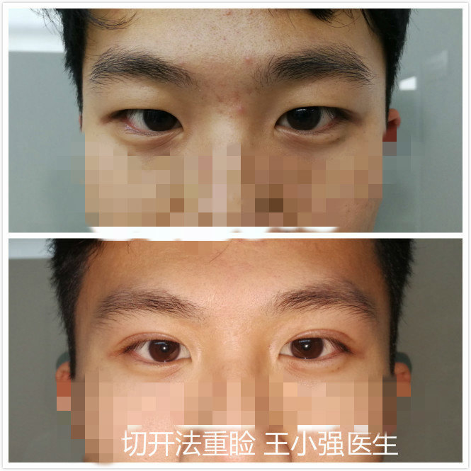 眼整形手术(双眼皮,眼袋,开眼角)_王小强医生文章_天津市眼科医院
