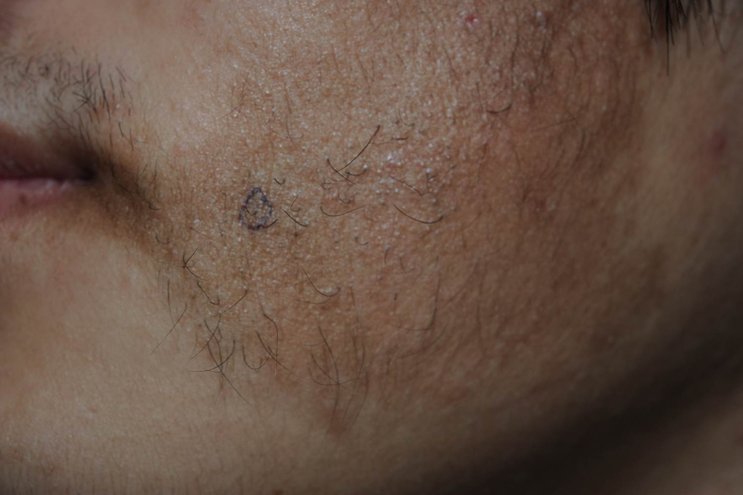 becker痣高出皮肤表面,边界不规则,表面可以伴有多毛及颗粒状毛周角化