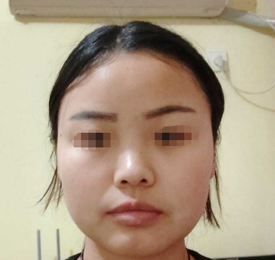 提眉之后出现了高低眉三角眼怎么办