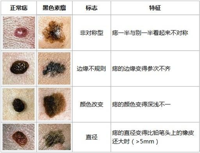 色素痣的鉴别与治疗