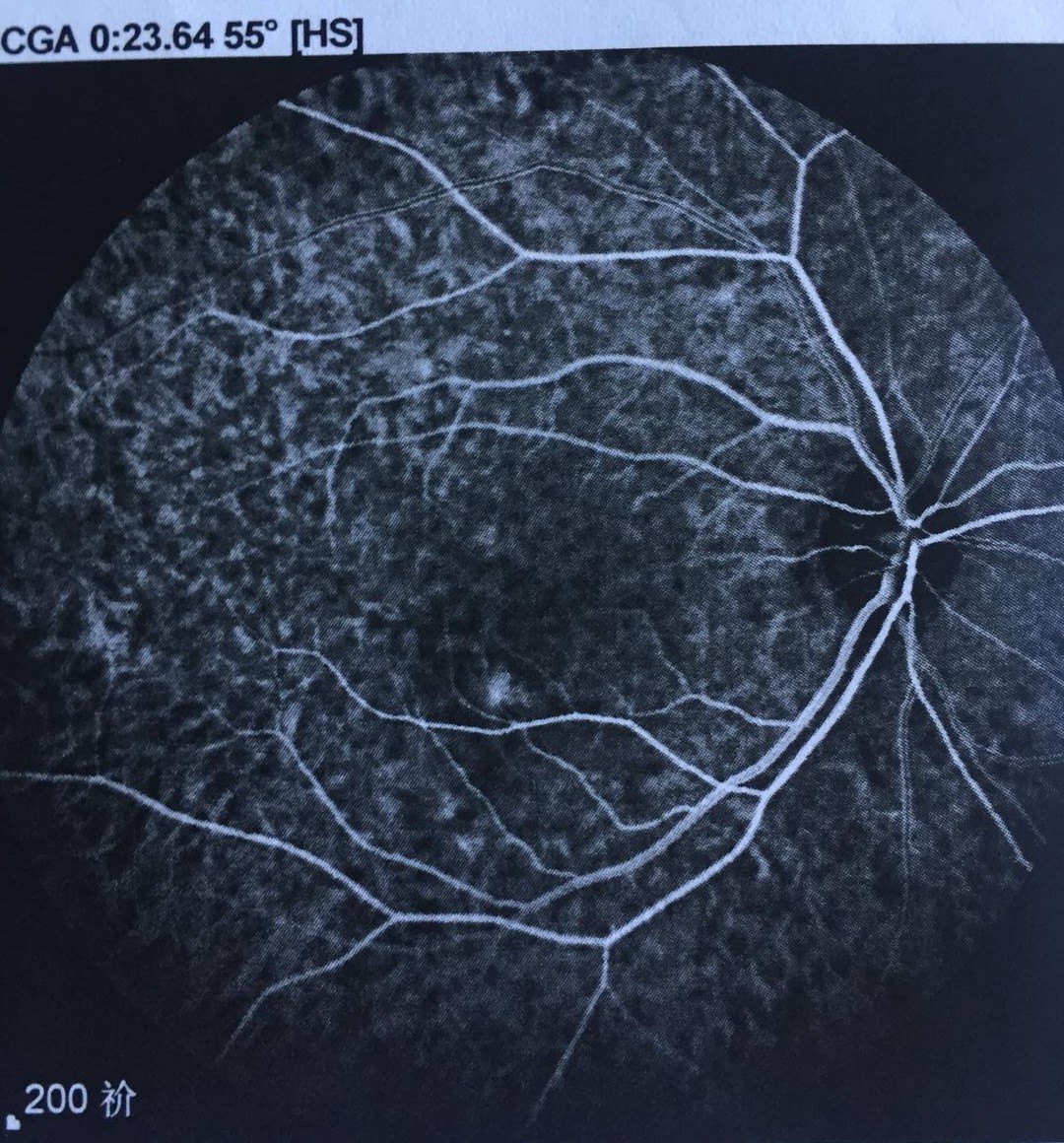 脉络膜渗漏图片