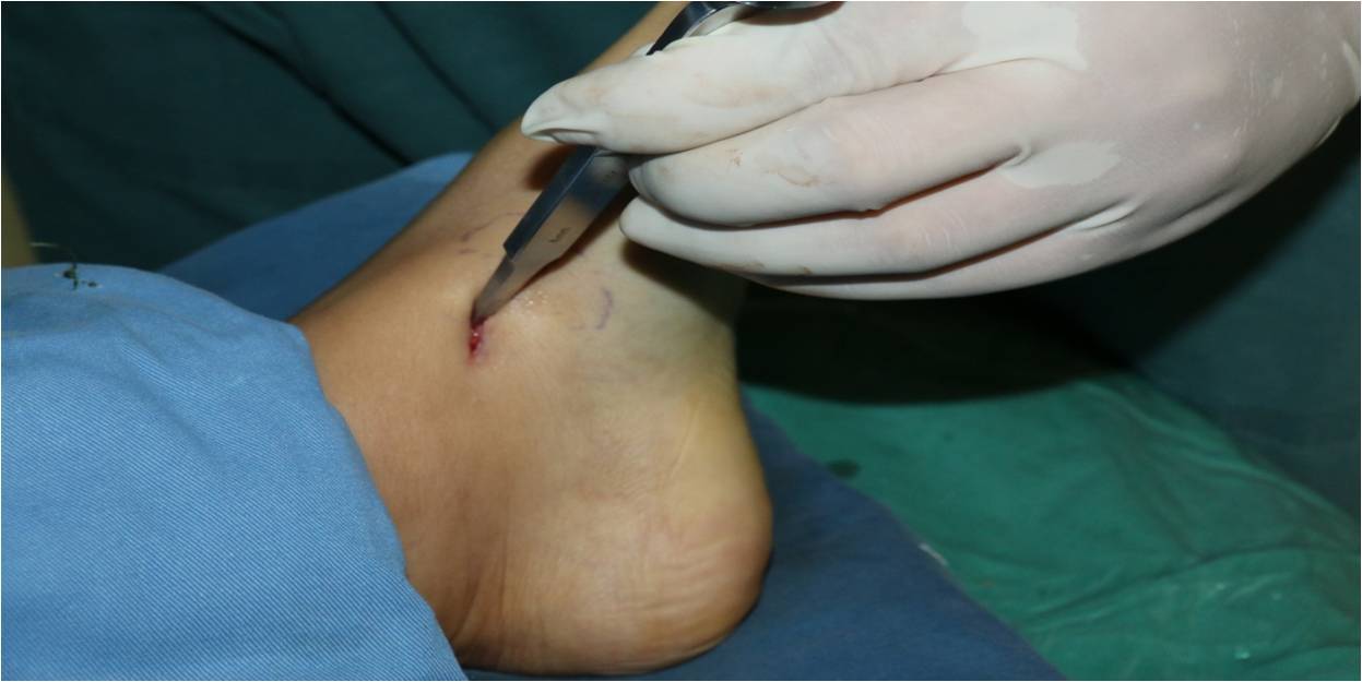 术前磁共振显示距骨囊肿新手术入路手术病例一:传统手术方法(内踝截骨