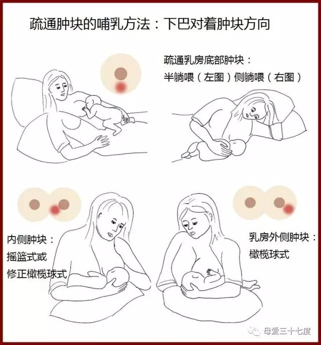 解决堵奶应急方法123