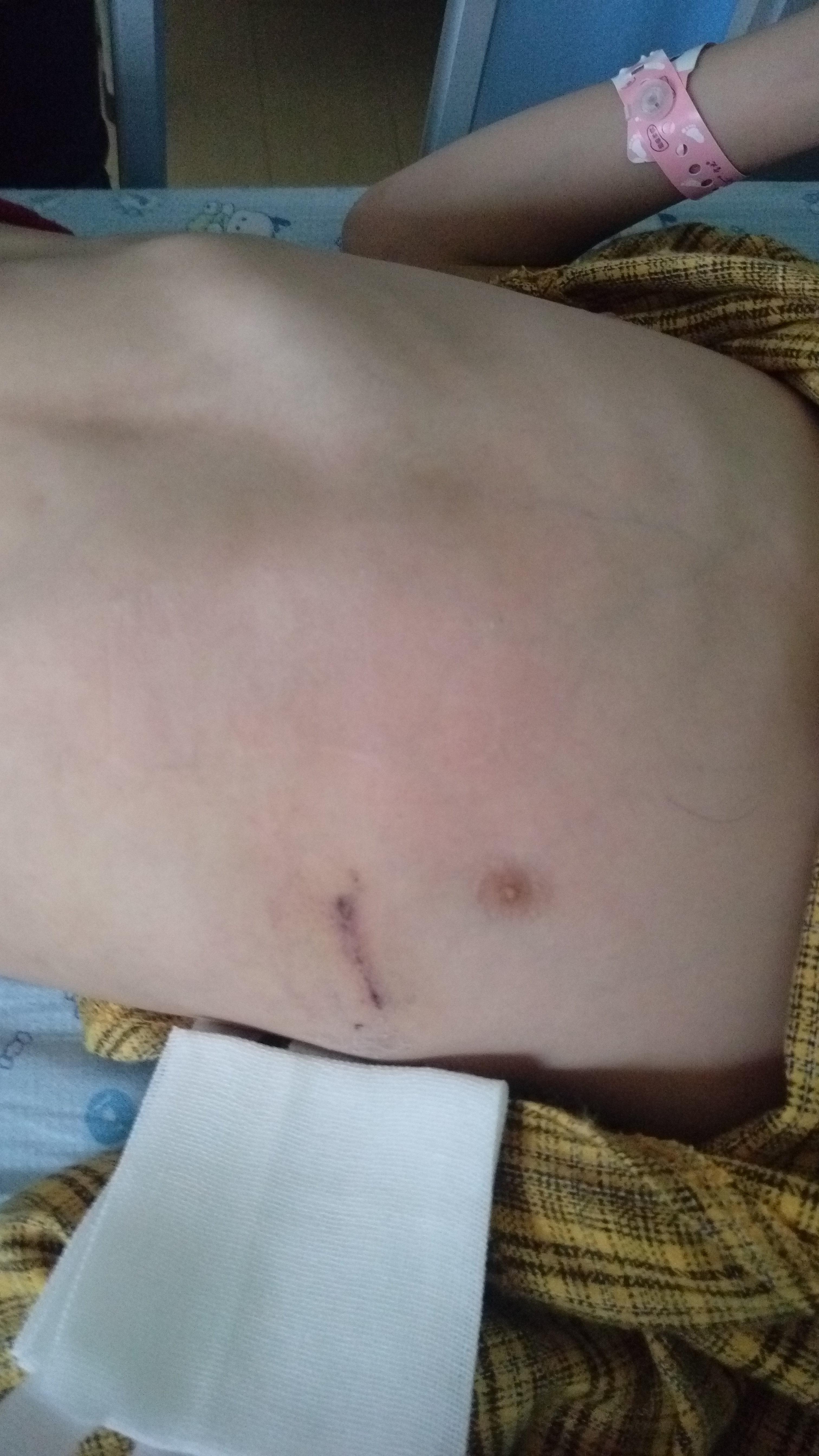 一一单孔微创漏斗胸手术矫形回顾