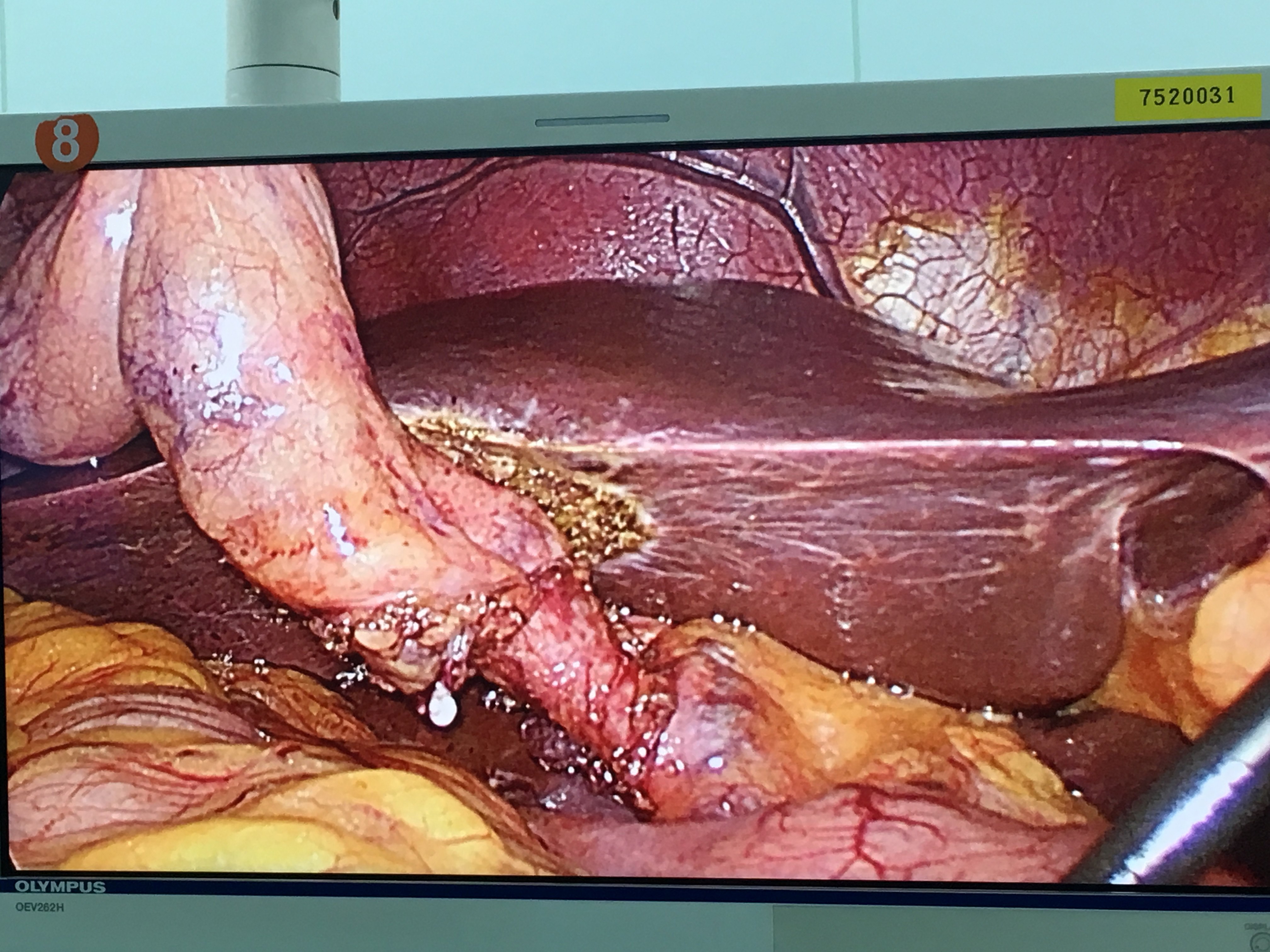 腹腔镜下胆囊切除术_王兆文医生文章_上海交通大学附属第一人民医院