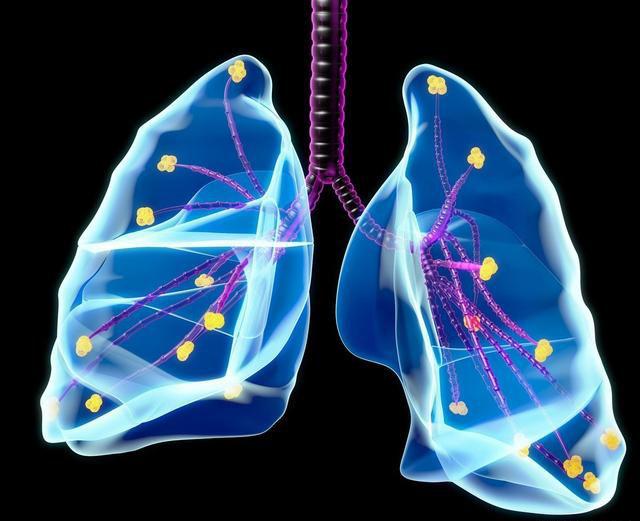 肺有结节怎么办 肺有结节怎么办