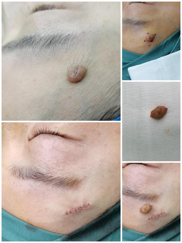 黑痣是怎么手术切除的