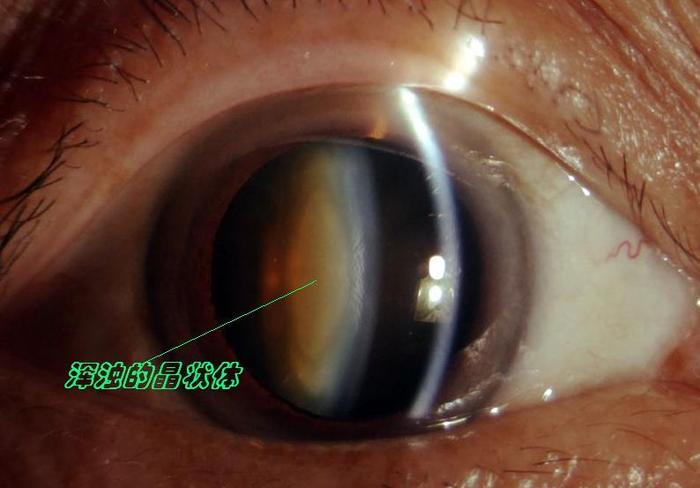 所谓一图胜千言,首先,我们看看白内障是什么:透明的晶状体变混浊后