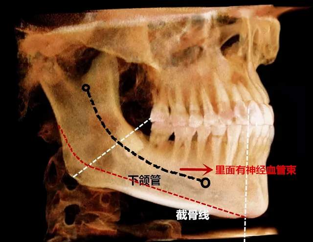 下颌角手术截下来的骨头多就是成功吗