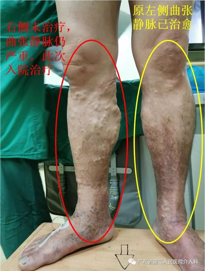 双腿重度静脉曲张变黑如何抚平