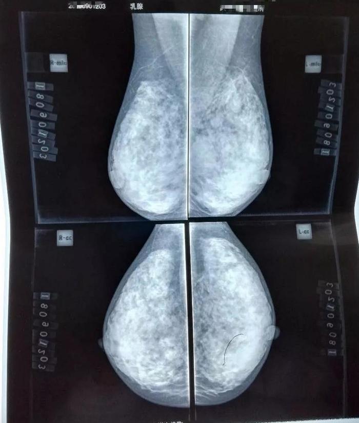 而粗大的钙化和单个的钙化是意义不大,因此,看钼靶片借助于放大镜