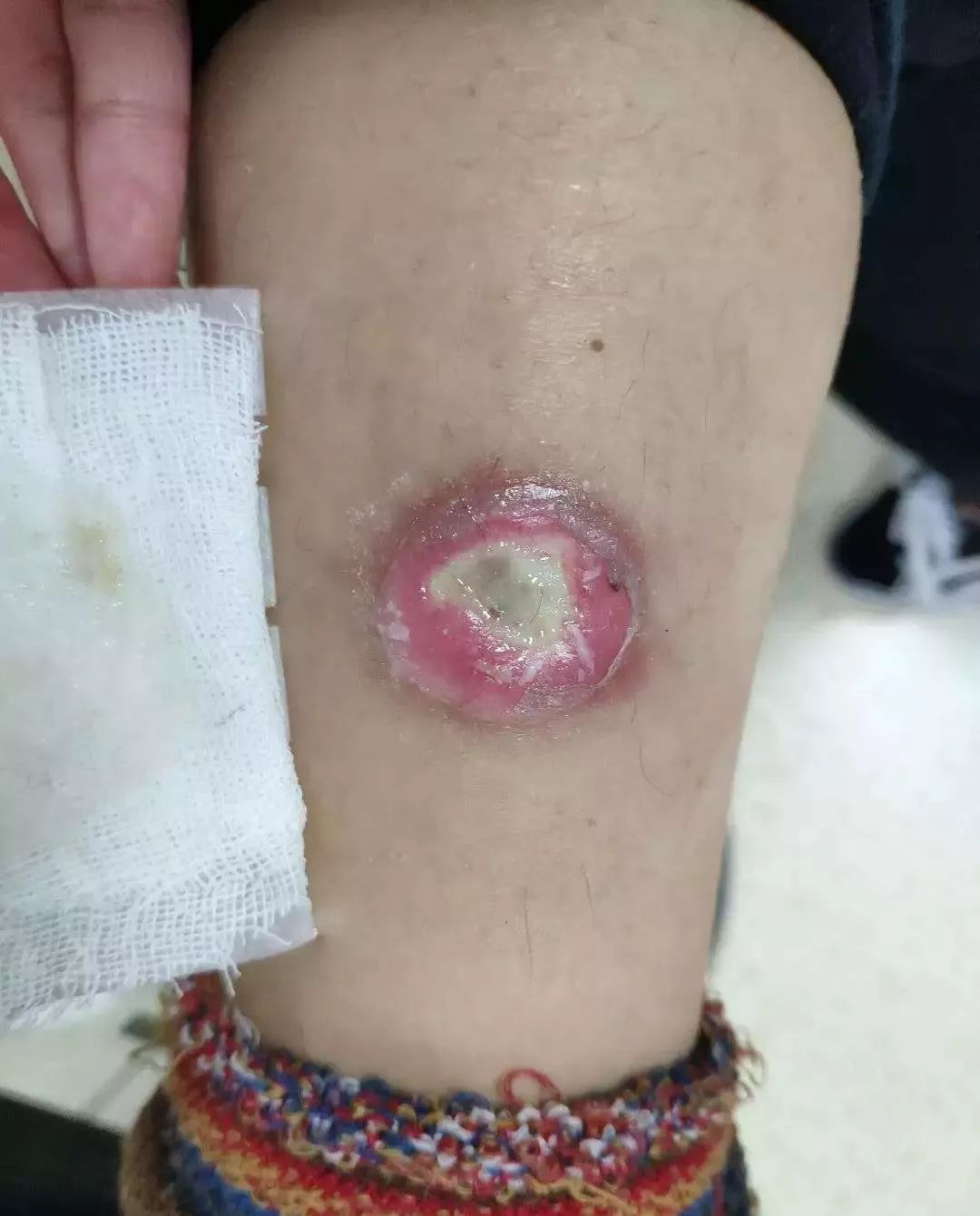 烫伤后有没有不用换药的治疗方案