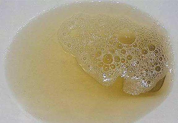 晨尿出现4种异常别大意多半尿酸已结晶痛风肾衰紧随其后