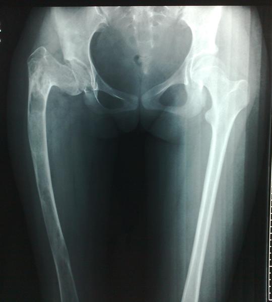 股骨近端骨纤维结构不良严重内翻畸形的矫形治疗