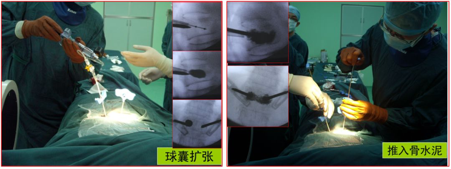 治疗骨质疏松压缩骨折的定海神针微创技术之椎体成形术