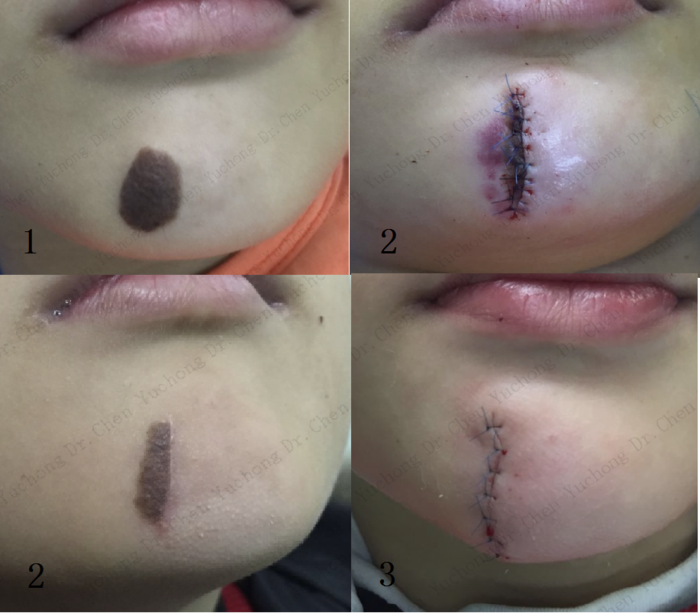 什么是胎记可以手术吗