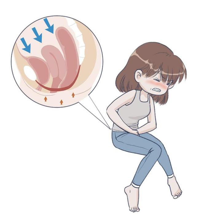 子宫脱垂的姐妹花阴道壁膨出