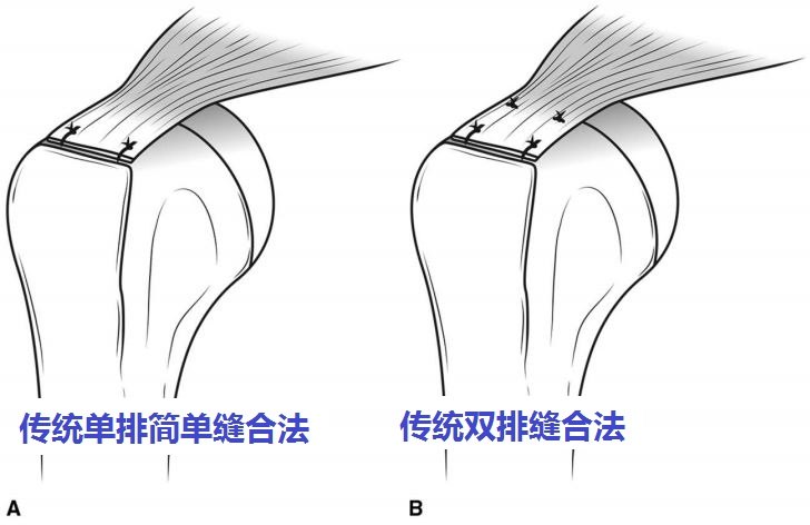 上图:三线单排简单缝合法.上图:缝线桥双排修复肩袖缝合法.