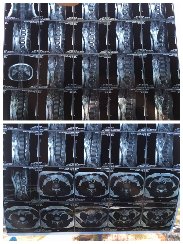 微义诊病例腰肌劳损了该怎么办