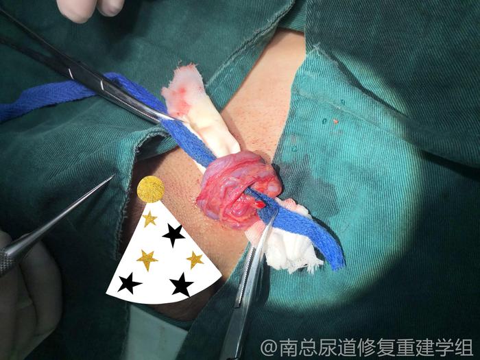 科普:体检查出精索静脉曲张,怎么办? - 微医(挂号网)