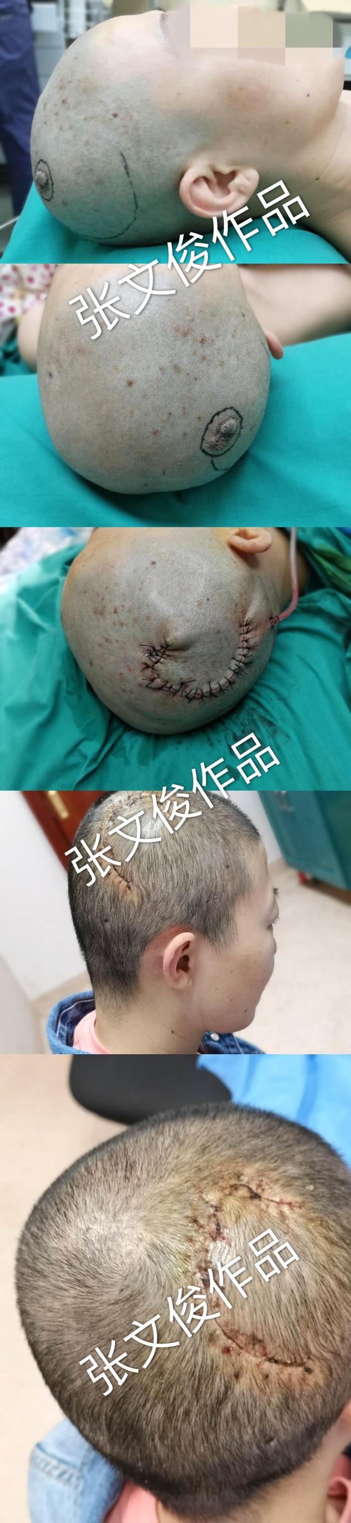 修复,完美修复创面,保留患者头发,术后不影响患者毛发生长病例特征