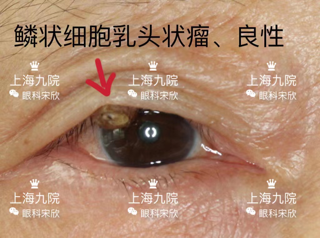 眼睑皮脂腺瘤图片