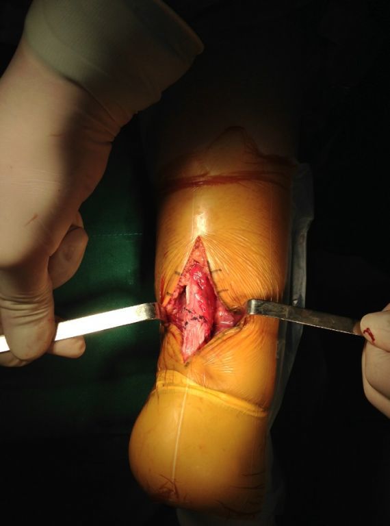 徐州二院骨科高绪仁:帮助越来越多踝关节运动损伤的患者康.