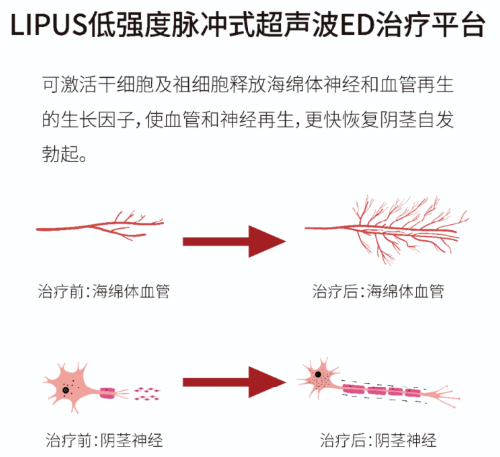 ed患者福音——lipus(低能量超声波)治疗仪 - 微医(挂号网)