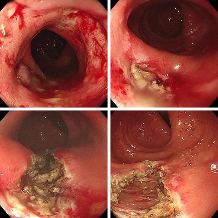 低位直肠癌保肛术后吻合口并发症看傅教授如何支招