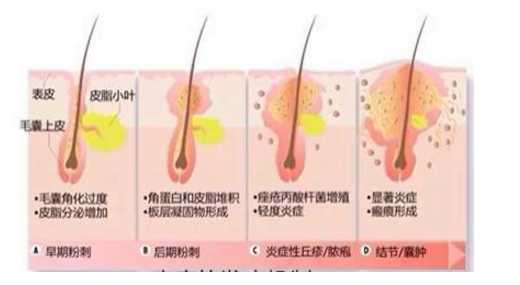 中国痤疮治疗指南(2014)