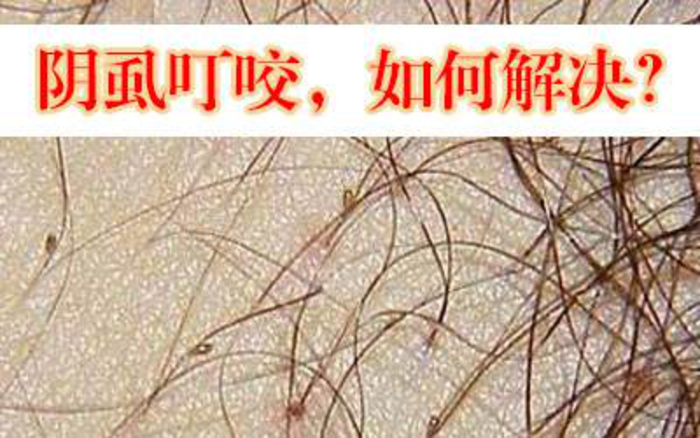 阴虱病严重吗怎么治疗好
