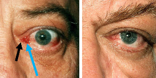 球结膜水肿.① 方法:a.