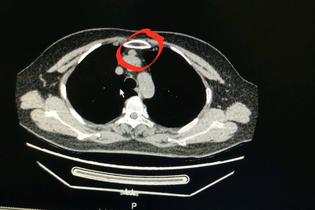 刘懿博士说肺癌(一五五九)前纵隔结节必须做核磁才知道是.