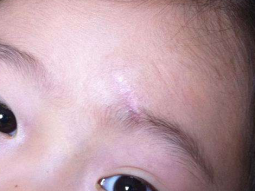 孩子脸上这种疤凹陷性瘢痕有救啦