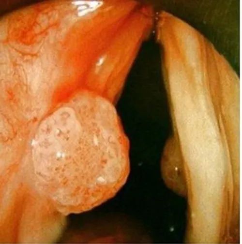 咽癌的早期症状图片图片