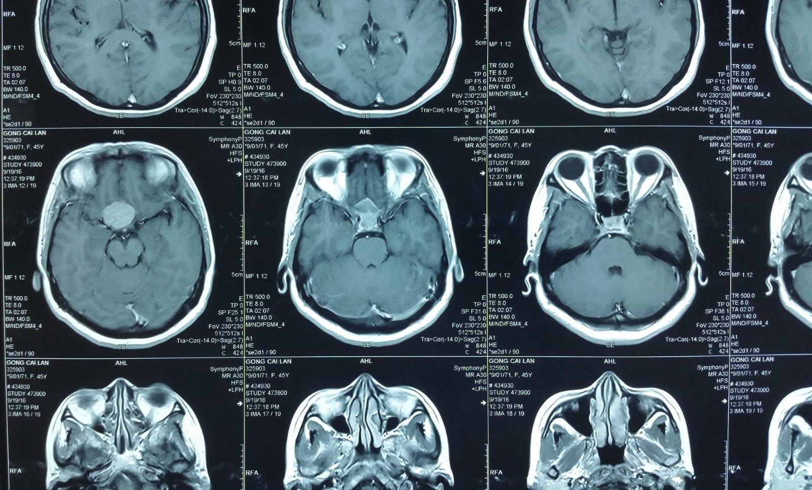 常见脑肿瘤的影像诊断 - 知乎
