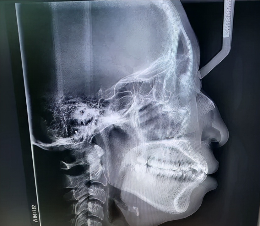 矫正前需明确真性突嘴与假性凸嘴