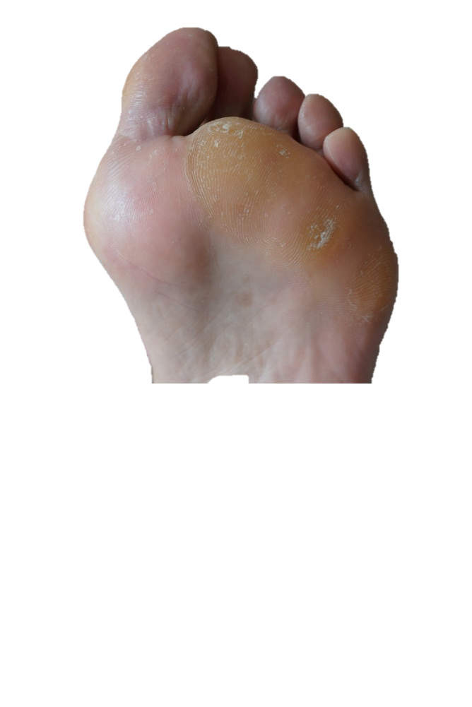 什么是拇外翻畸形