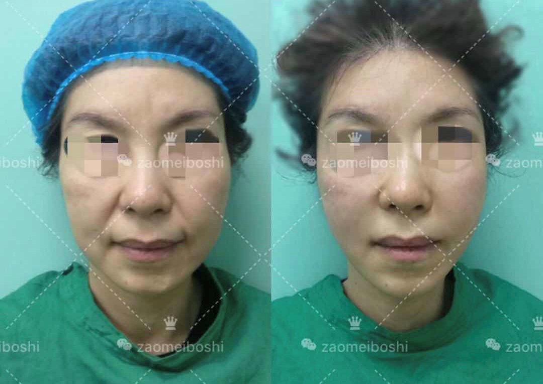 微拉美面部提升术_面部v拉提升手术视频_面部提拉微整形