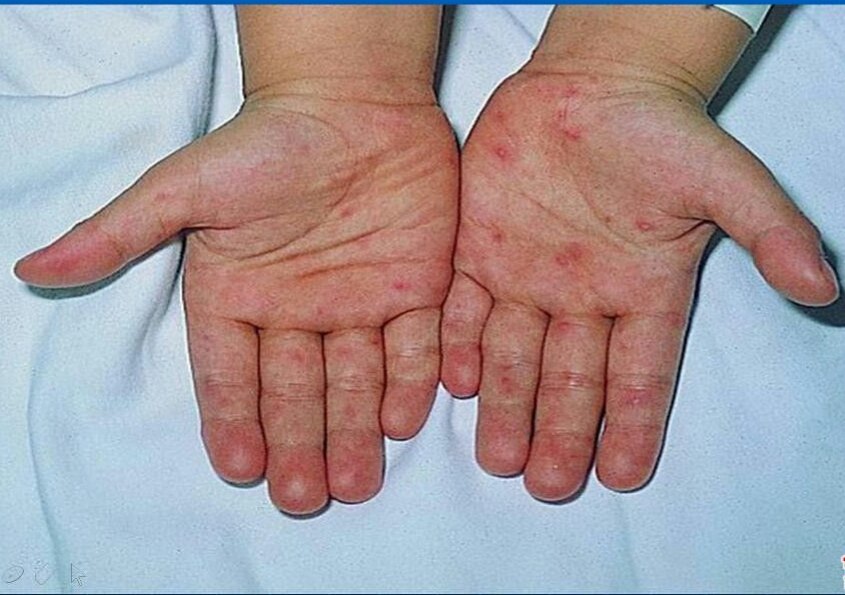 手足口病皮疹特点