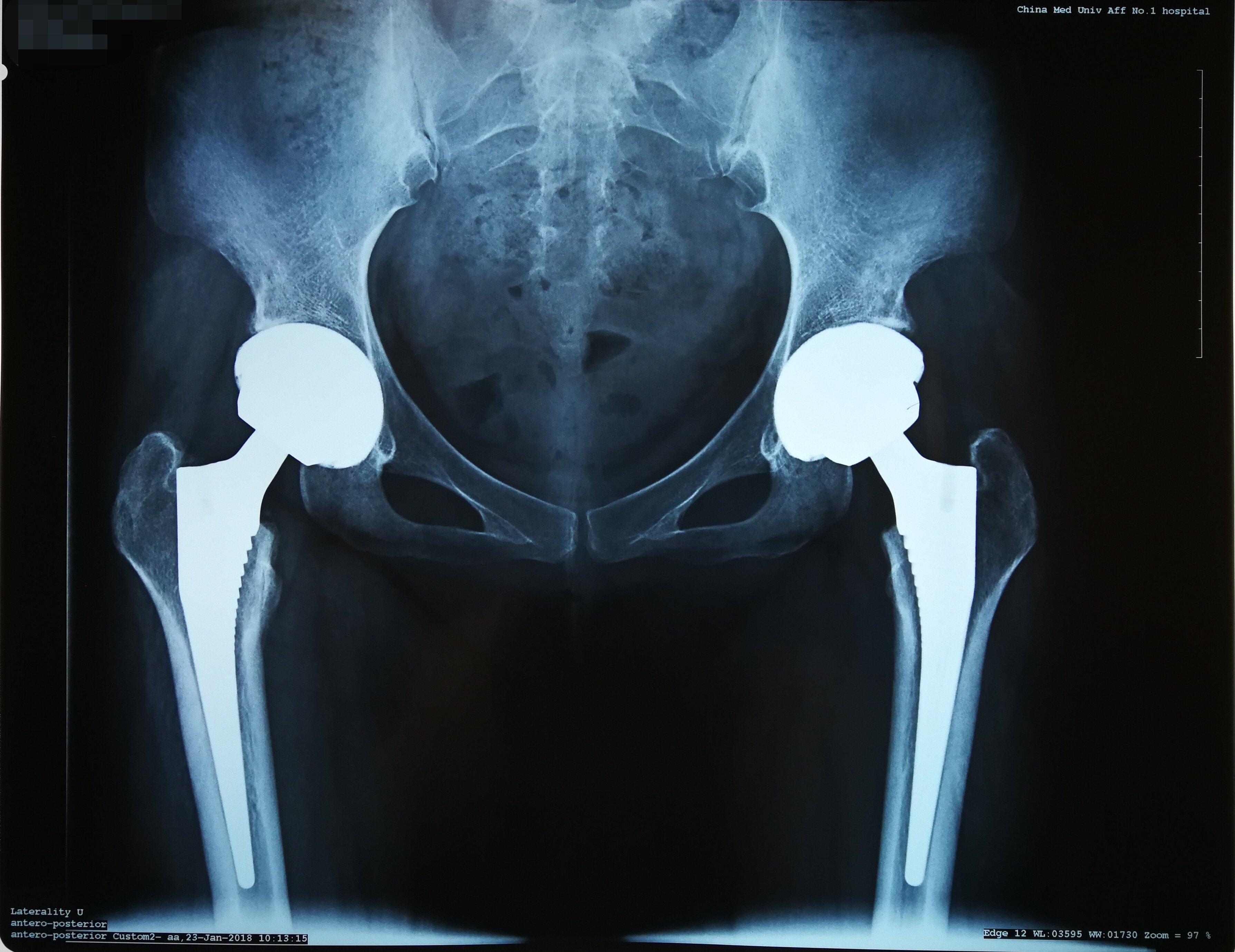 股骨头坏死人工全髋关节置换术