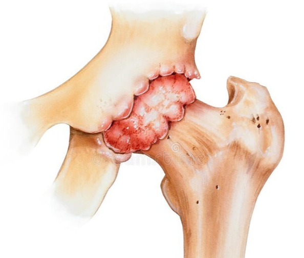髋关节滑膜炎什么情况下必须手术治疗