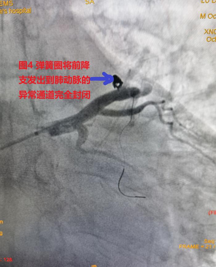 冠状动脉肺动脉瘘不开胸能治愈吗