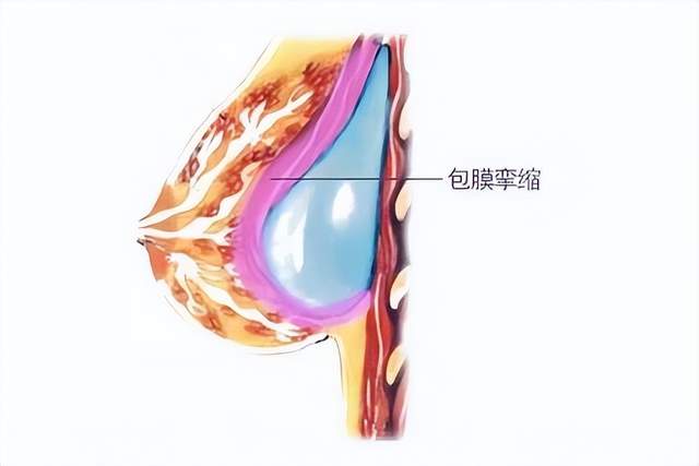 它是人体对异物的一种自然反应,对于限制假体移位,将假体与身体隔离有