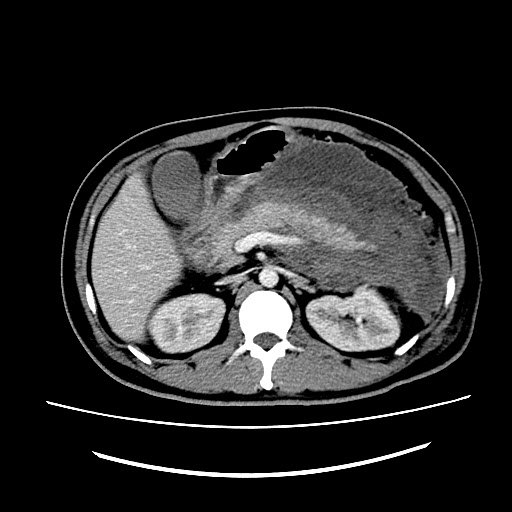 术前ct提示重症急性胰腺炎合并胰腺周围感染和积脓经过经皮穿刺置管