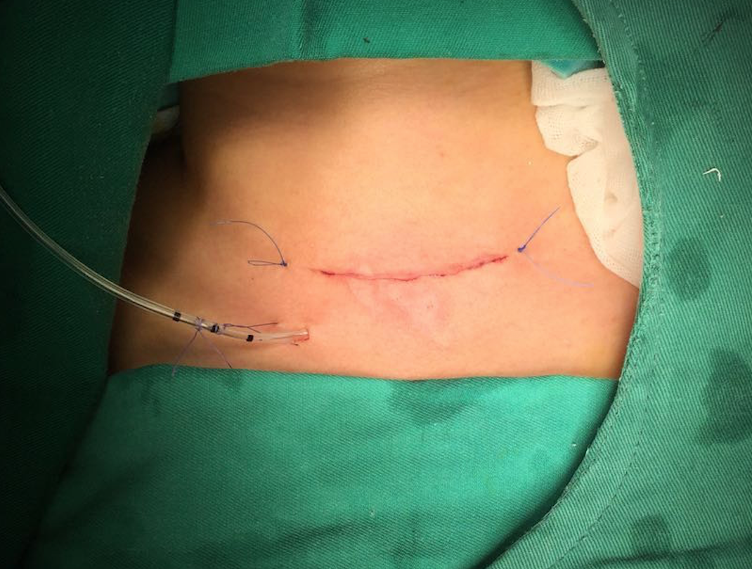 王医生缝合的切口手术进行中:一台手术的顺利完成是由手术医生,主治