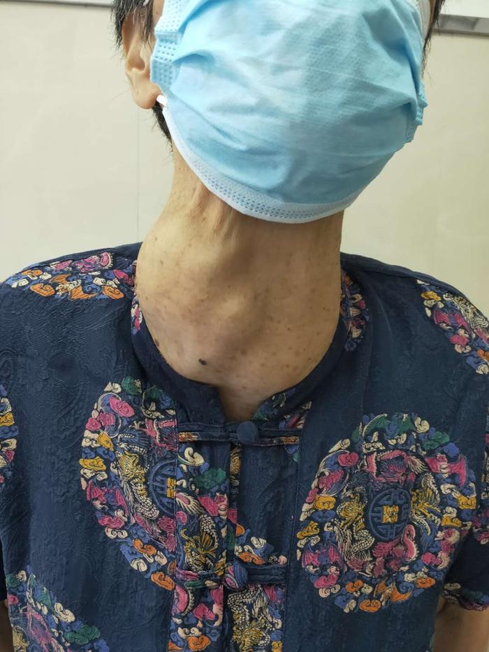 病友故事80岁老太太巨大甲状腺包块术后解除7年顽疾