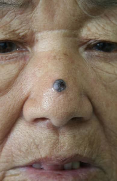 鼻子皮肤癌图片图片